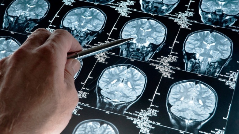 Científicos descubren cómo mueren las células cerebrales en el Alzheimer